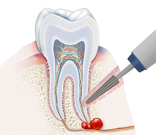 Резекция зуба