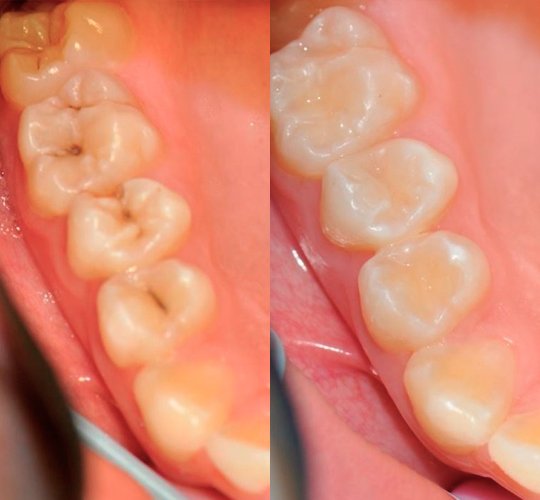 Особенности подростковых зубов