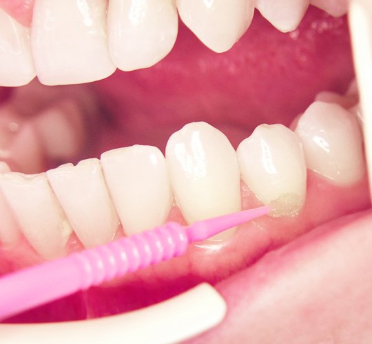 Преимущества и показания к фторированию зубов