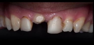 Зубы до установки имплантов