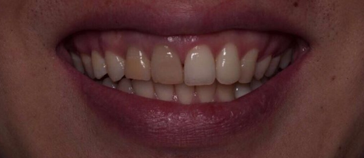 Зубы до установки виниров