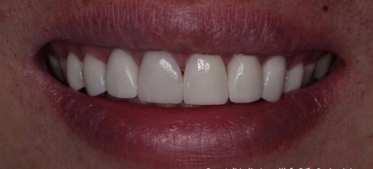 Зубы после установки виниров