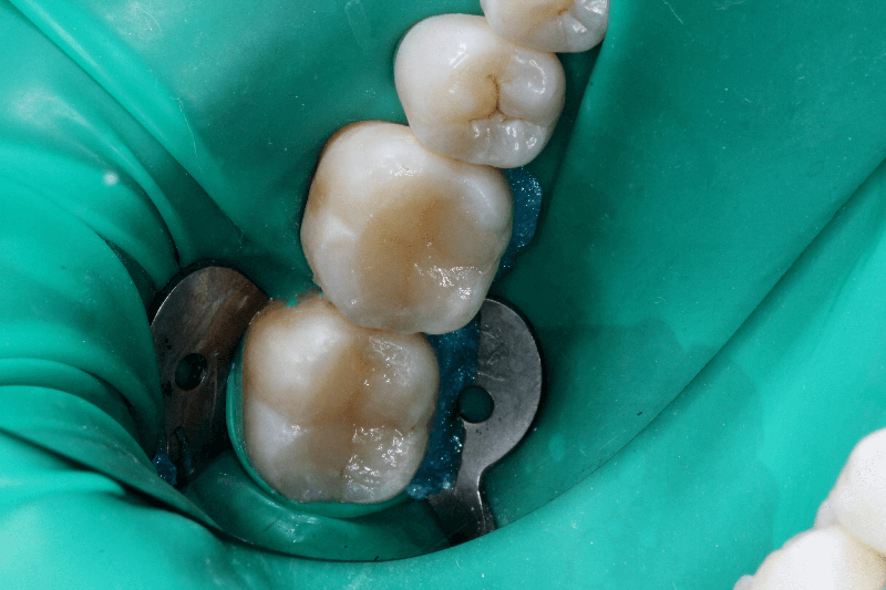 Зубы после наращивания