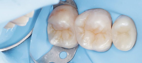 Зубы после