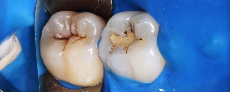 Лечение кариеса зубов в новосибирске