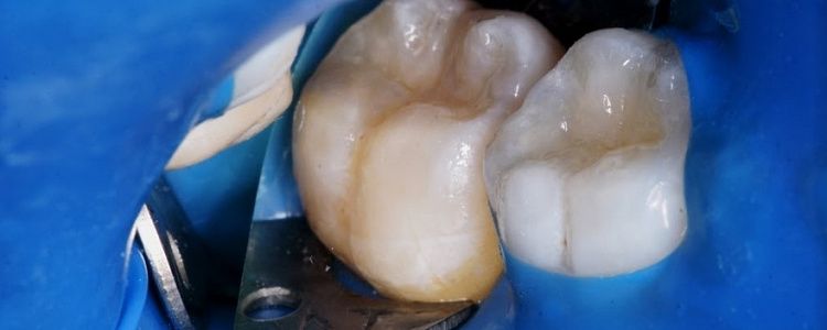 Лечение кариеса зубов в новосибирске